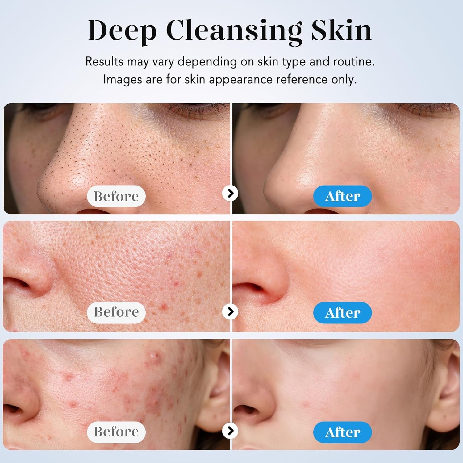 Skin Scrubber Face Spatula Skin Spatula Pore Cleaner Blackhead Remover Tools for Facial Deep Cleansing-4 Modes -White