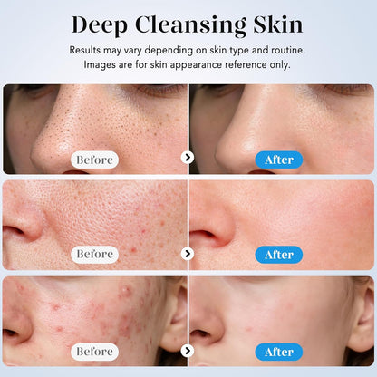 Skin Scrubber Face Spatula Skin Spatula Pore Cleaner Blackhead Remover Tools for Facial Deep Cleansing-4 Modes -White