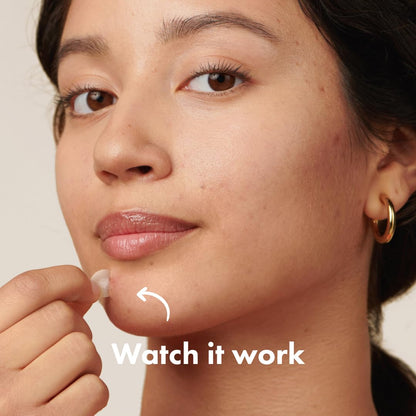 Original Patch from Hero Cosmetics – the #1 Hydrocolloid Acne Pimple Patch for Shrinking Zits and Whiteheads in 1 Use; Nighttime Spot Stickers for Face and Skin (72 Count)